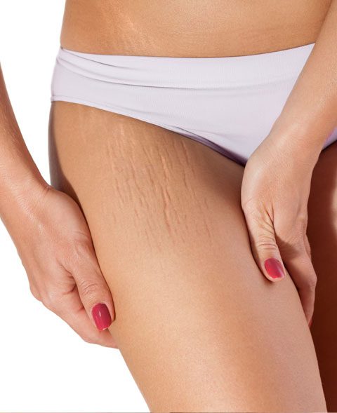 stretch marks